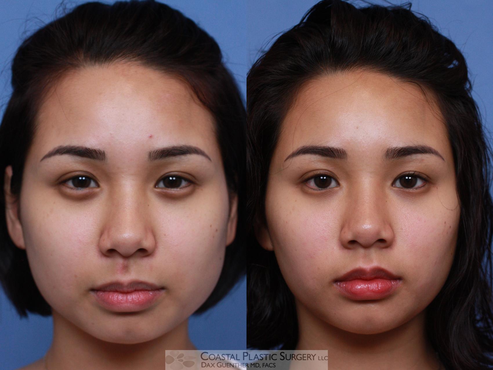 Before & After Botox & Dysport Case 106 Front View in Boston, MA