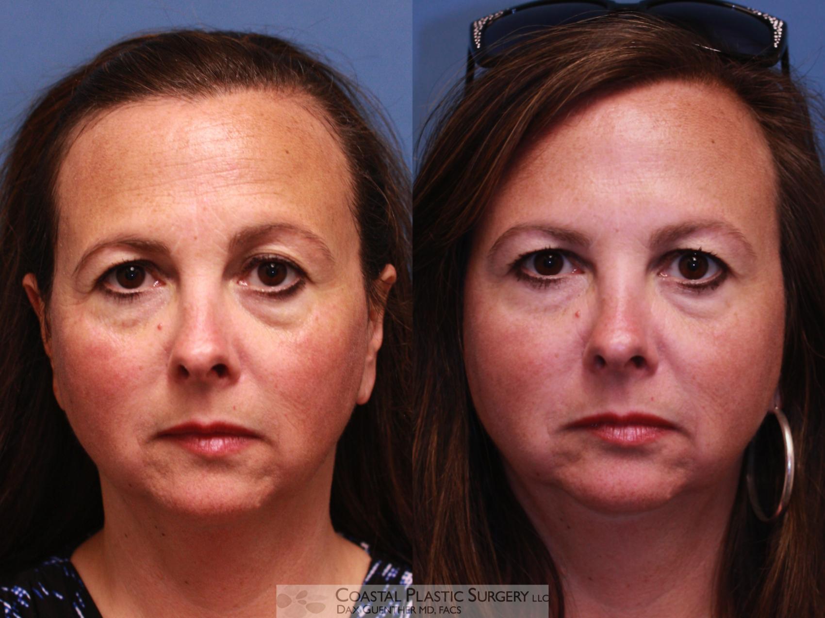 Before & After Botox & Dysport Case 31 In Repose View in Boston, MA