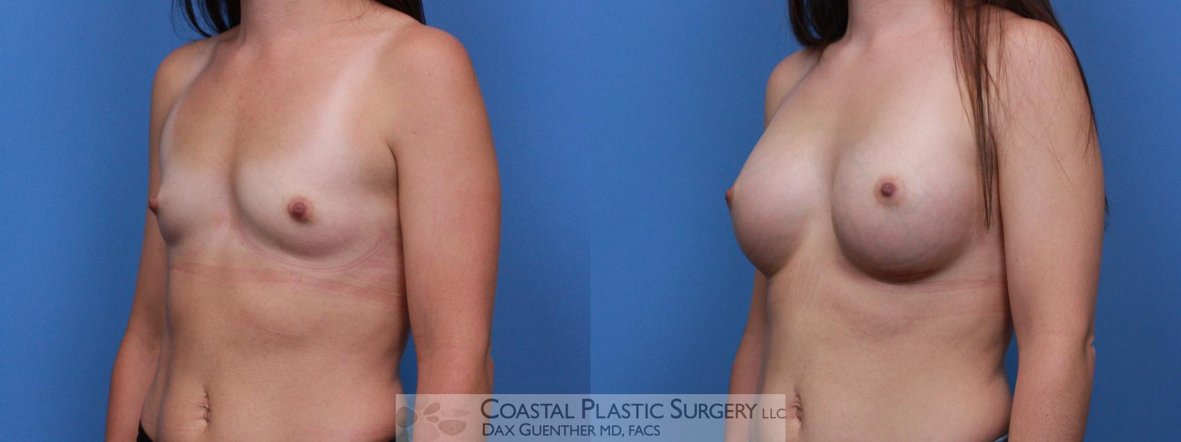 Before & After Breast Augmentation Case 102 Left Oblique View in Boston, MA
