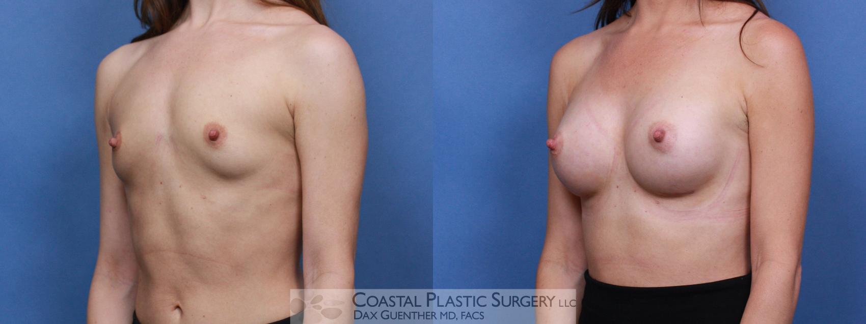 Before & After Breast Augmentation Case 103 Left Oblique View in Boston, MA