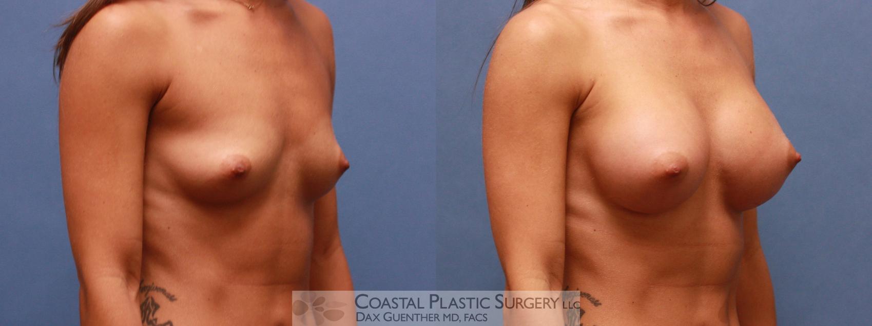 Before & After Breast Augmentation Case 48 View #1 View in Boston, MA