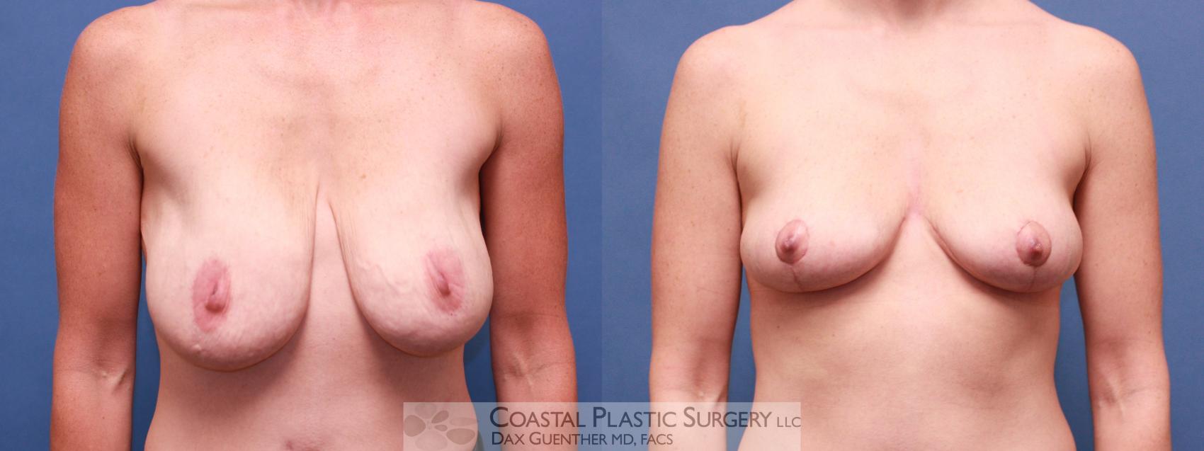 Before & After Breast Lift Case 15 View #1 View in Boston, MA