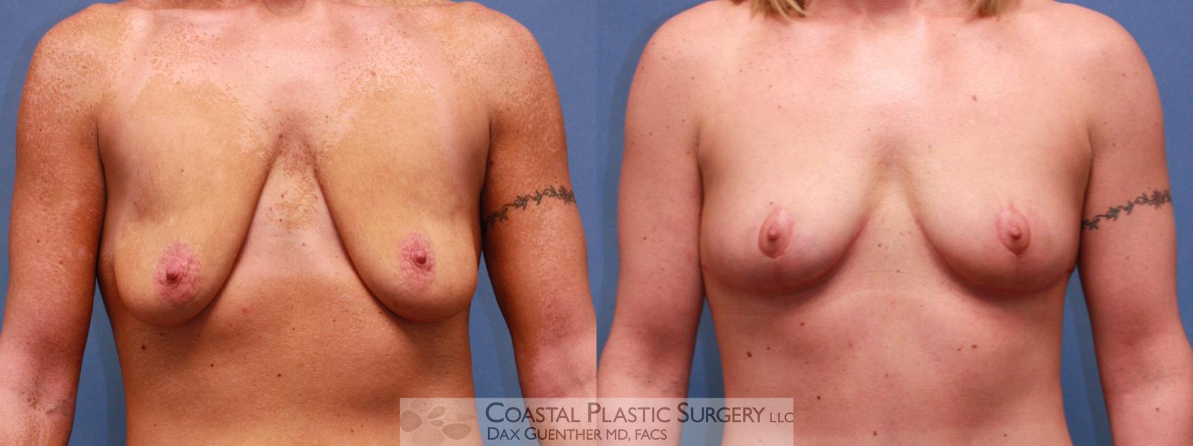 Before & After Breast Lift Case 38 View #1 View in Boston, MA