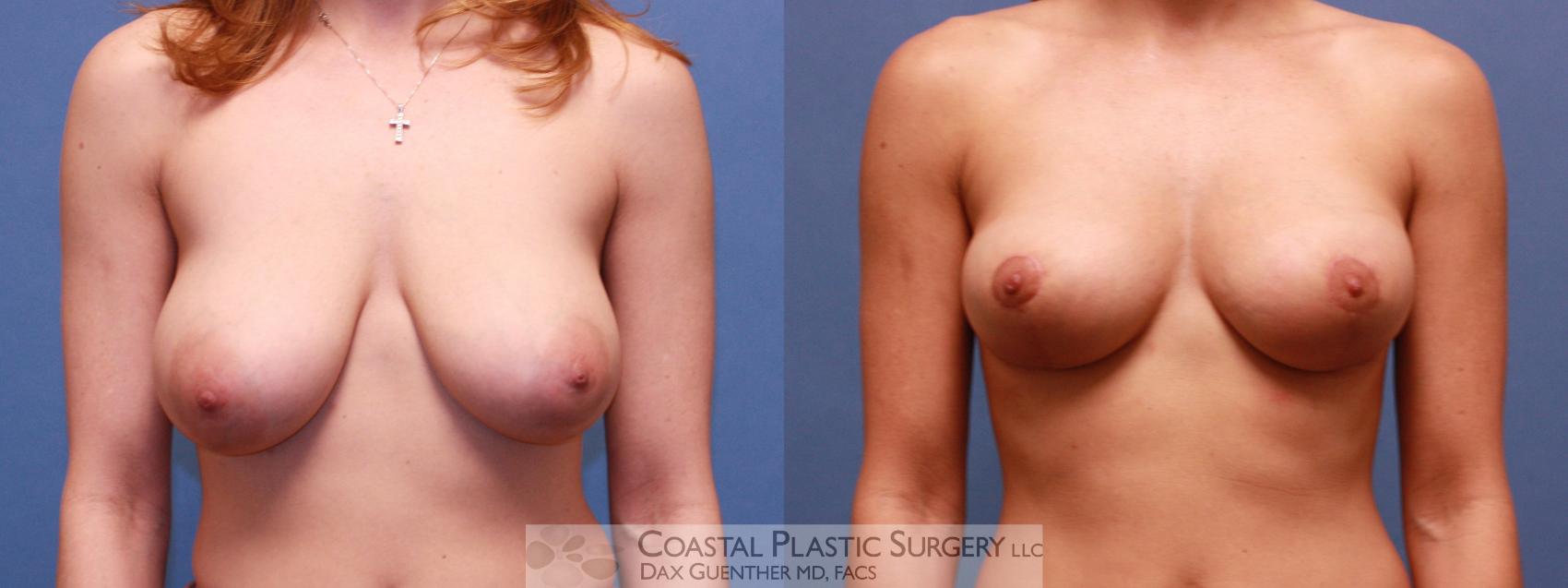 Before & After Breast Lift Case 42 View #1 View in Boston, MA