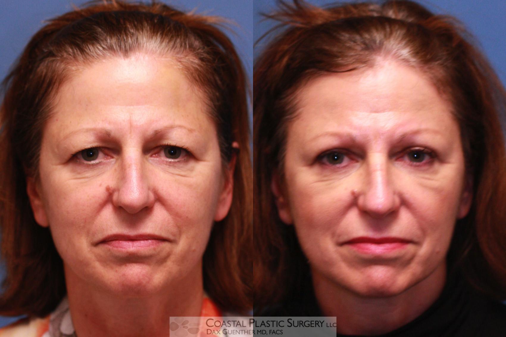 Before & After Brow Lift Case 32 View #1 View in Boston, MA