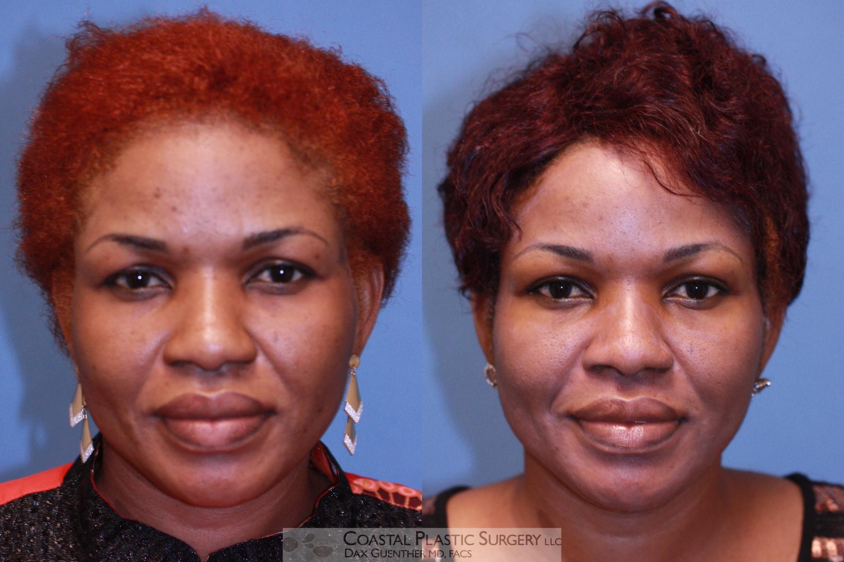 Before & After Brow Lift Case 41 View #1 View in Boston, MA