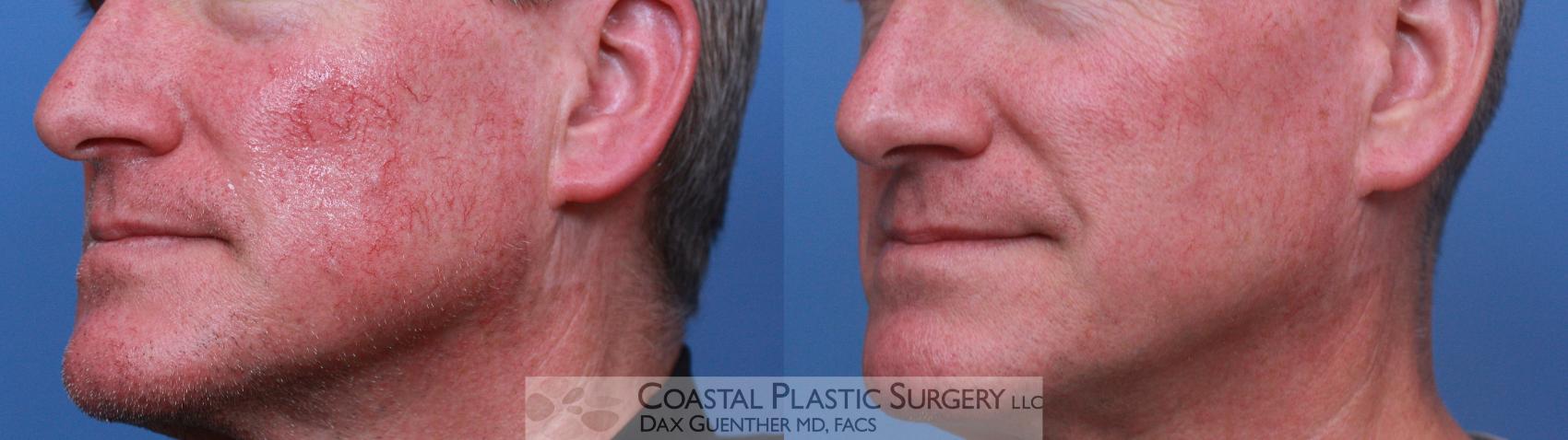 Before & After Chemical Peels & Lasers/Lights Case 119 Left Oblique View in Boston, MA