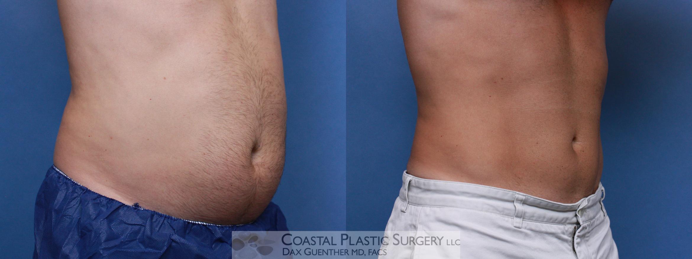 Before & After CoolSculpting Case 104 Right Oblique View in Hingham, Boston & Nantucket, MA