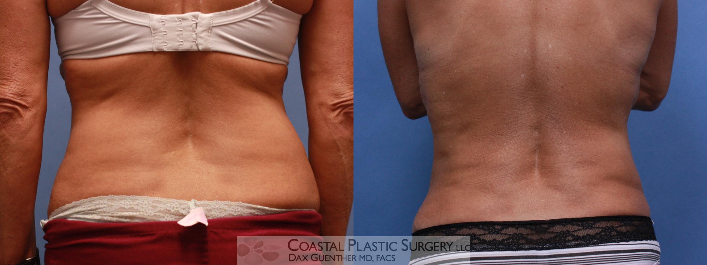 Before & After CoolSculpting Case 110 Back View in Hingham, Boston & Nantucket, MA