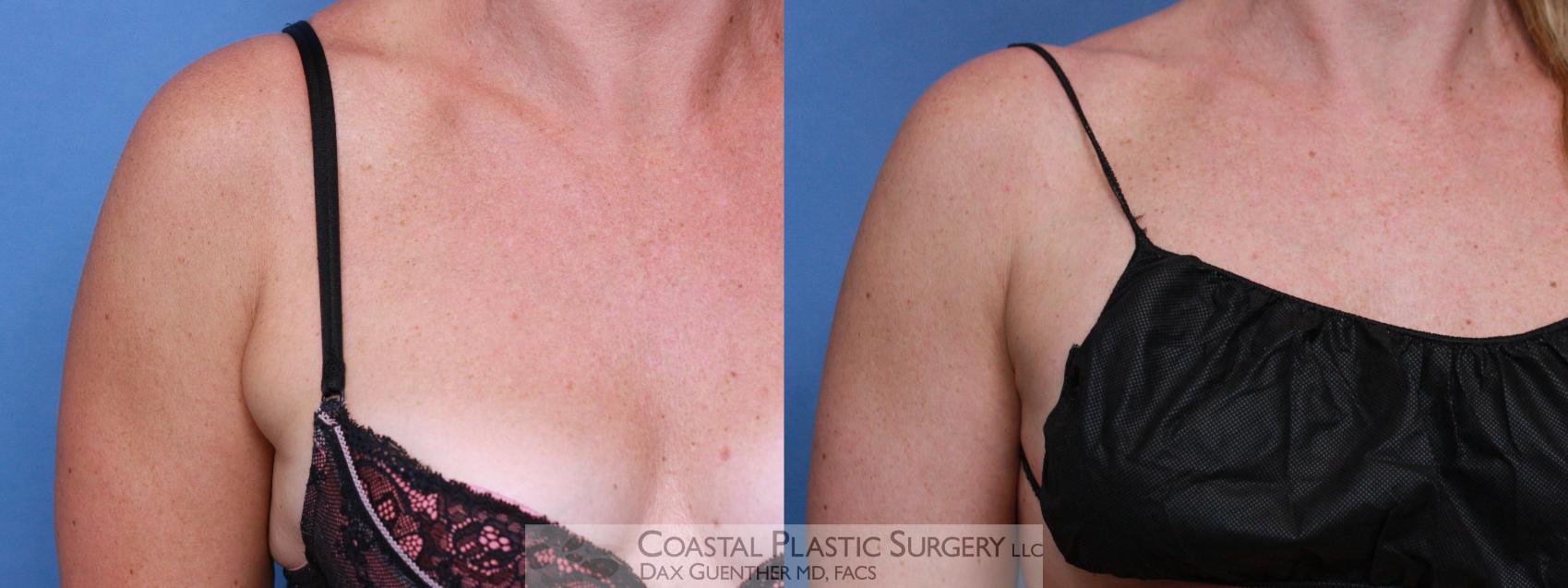Before & After CoolSculpting® Elite Case 105 Front View in Boston, MA