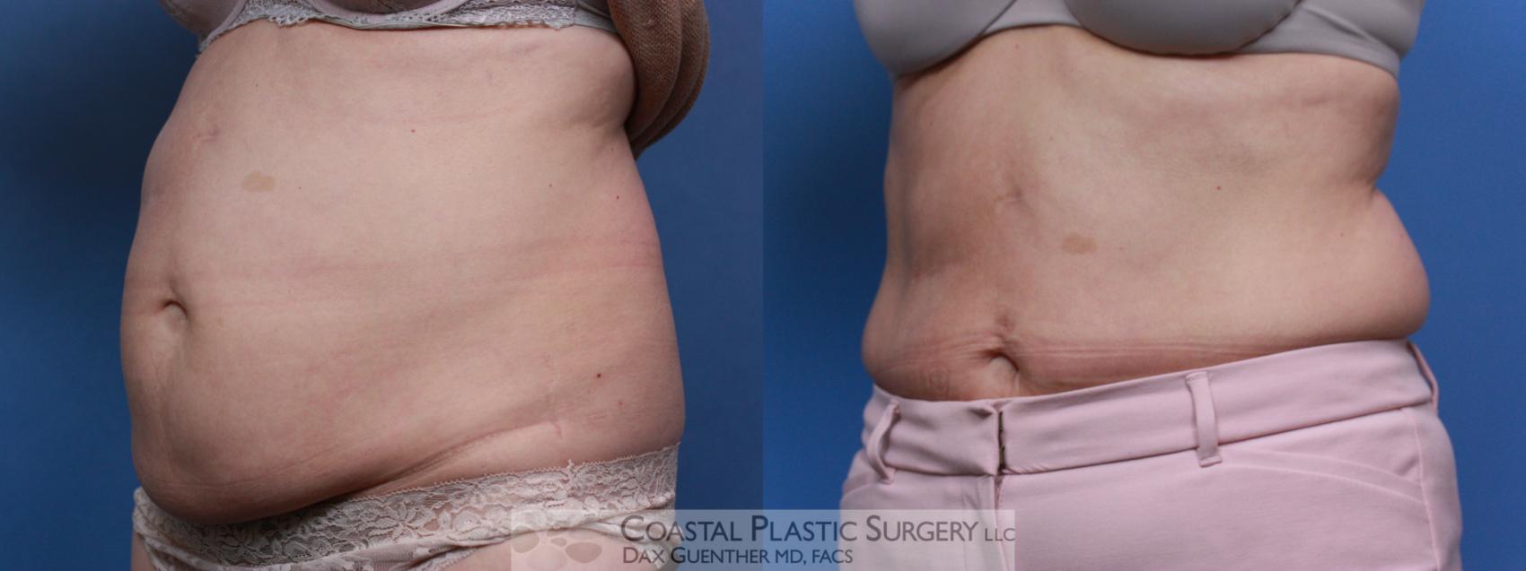 Before & After CoolSculpting® Elite Case 109 Left Oblique View in Boston, MA