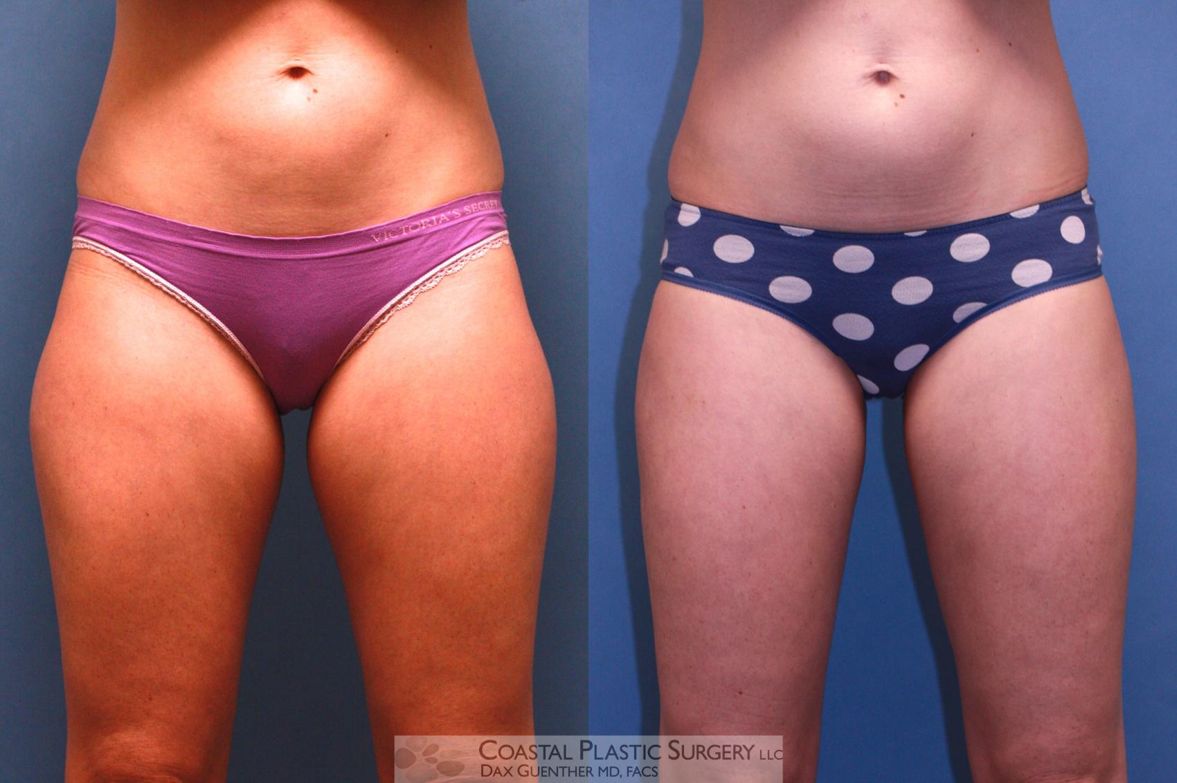Before & After CoolSculpting® Elite Case 36 View #1 View in Boston, MA
