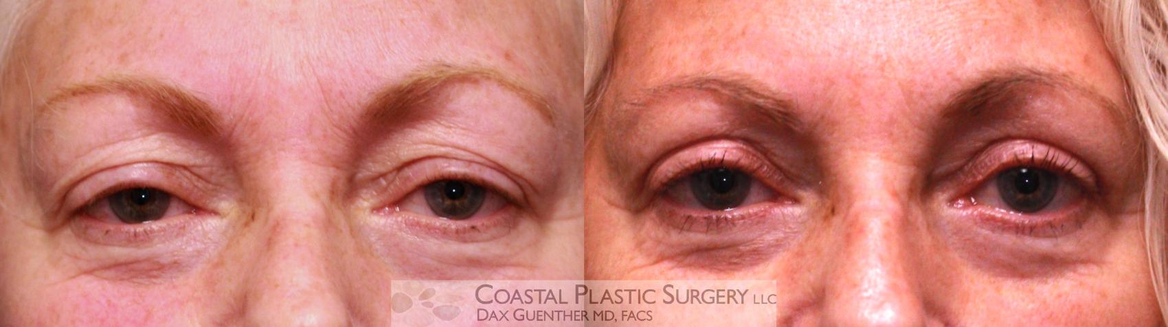 Before & After Eyelid Surgery (Blepharoplasty) Case 25 View #1 View in Boston, MA