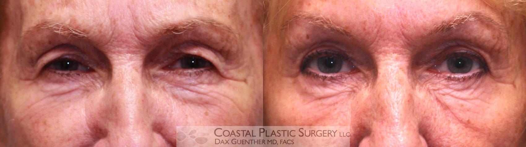 Before & After Eyelid Surgery (Blepharoplasty) Case 26 View #1 View in Boston, MA