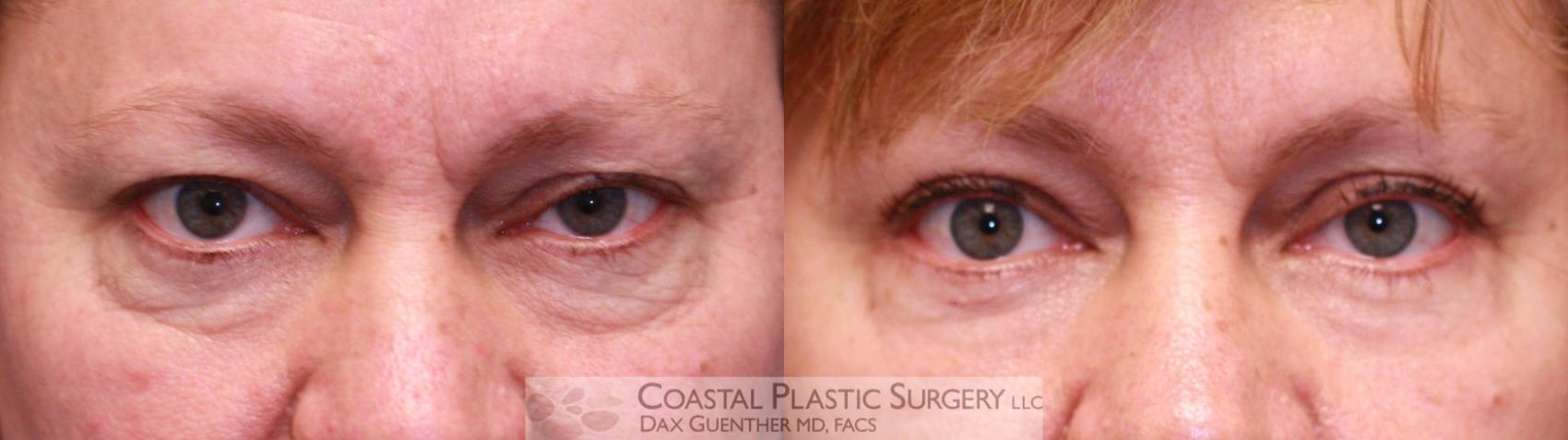 Before & After Eyelid Surgery (Blepharoplasty) Case 47 View #1 View in Boston, MA