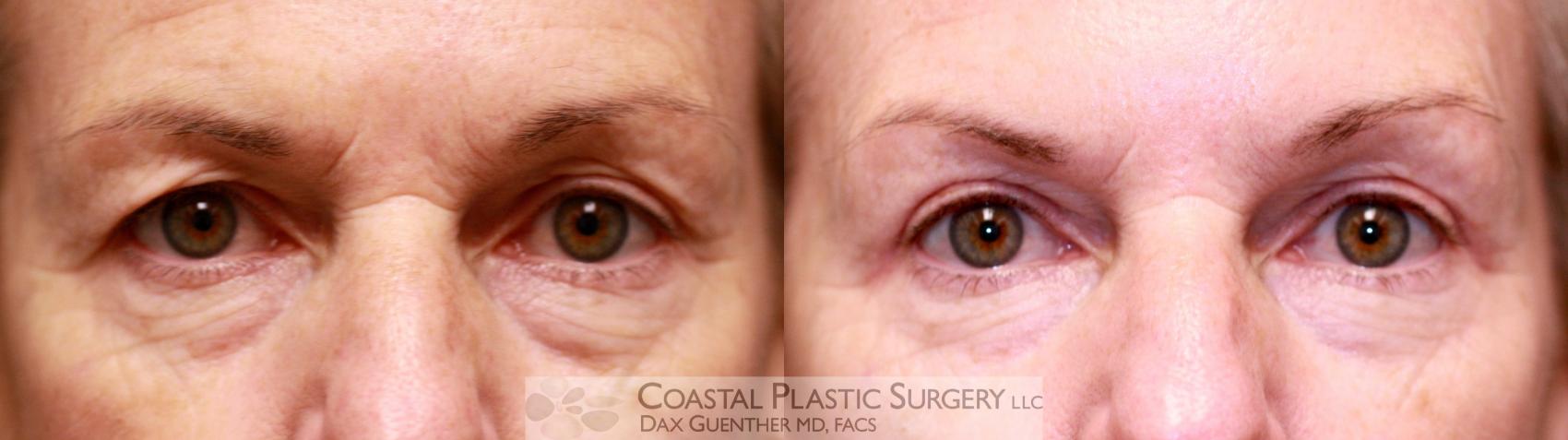 Before & After Eyelid Surgery (Blepharoplasty) Case 49 View #1 View in Boston, MA