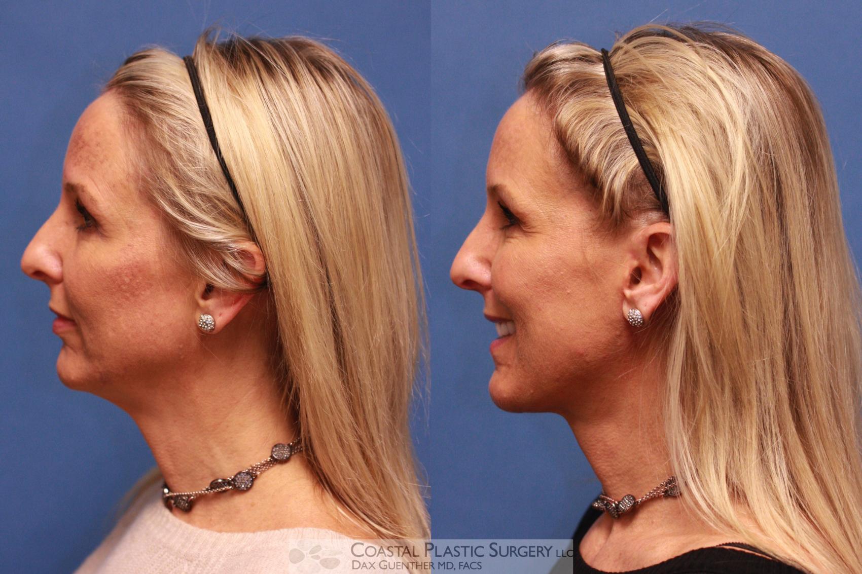 Before & After Face/Neck Lift Case 14 View #1 View in Boston, MA