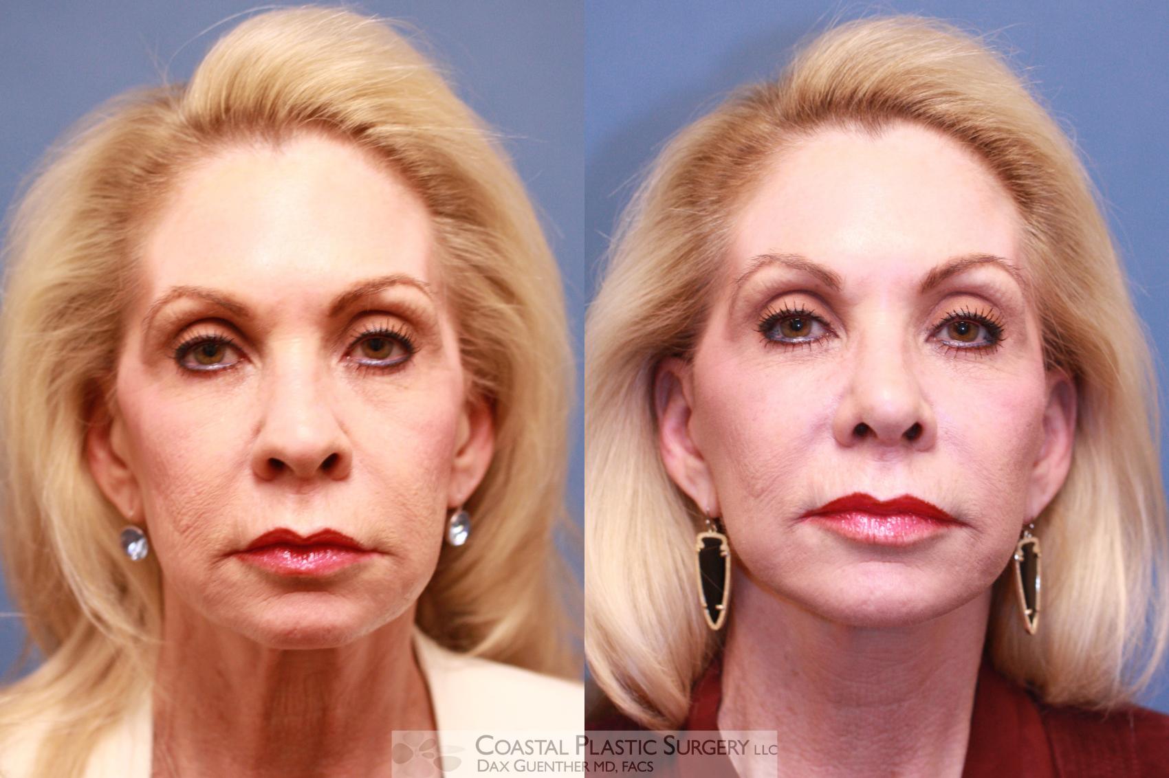 Before & After Face/Neck Lift Case 70 View #2 View in Boston, MA