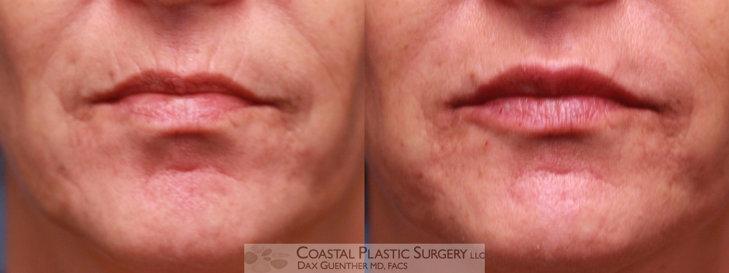 Before & After Fillers & Threads Case 7 Front View in Hingham, Boston & Nantucket, MA