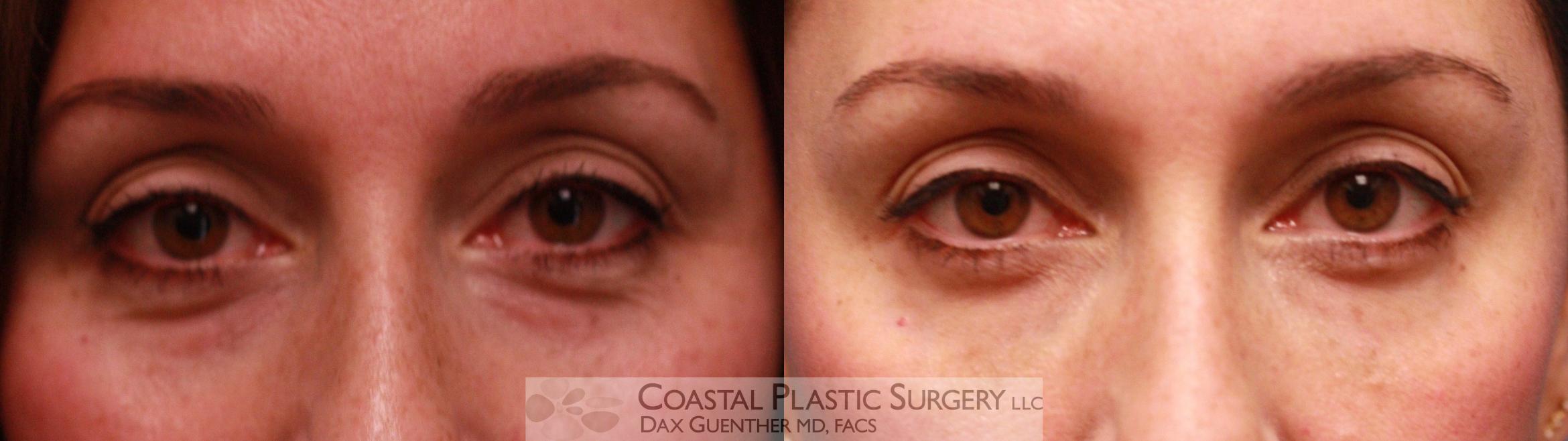 Before & After Fillers & Threads Case 74 Front View in Hingham, Boston & Nantucket, MA