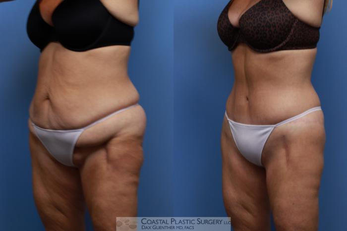 Before & After Lower Body Lift / Belt Lipectomy Case 137 Left Oblique View in Boston, MA