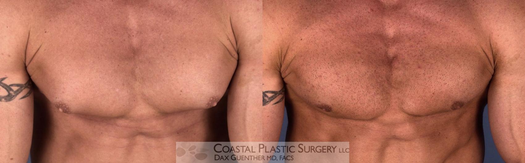 Before & After Male Breast Reduction (Gynecomastia) Case 2 View #1 View in Boston, MA