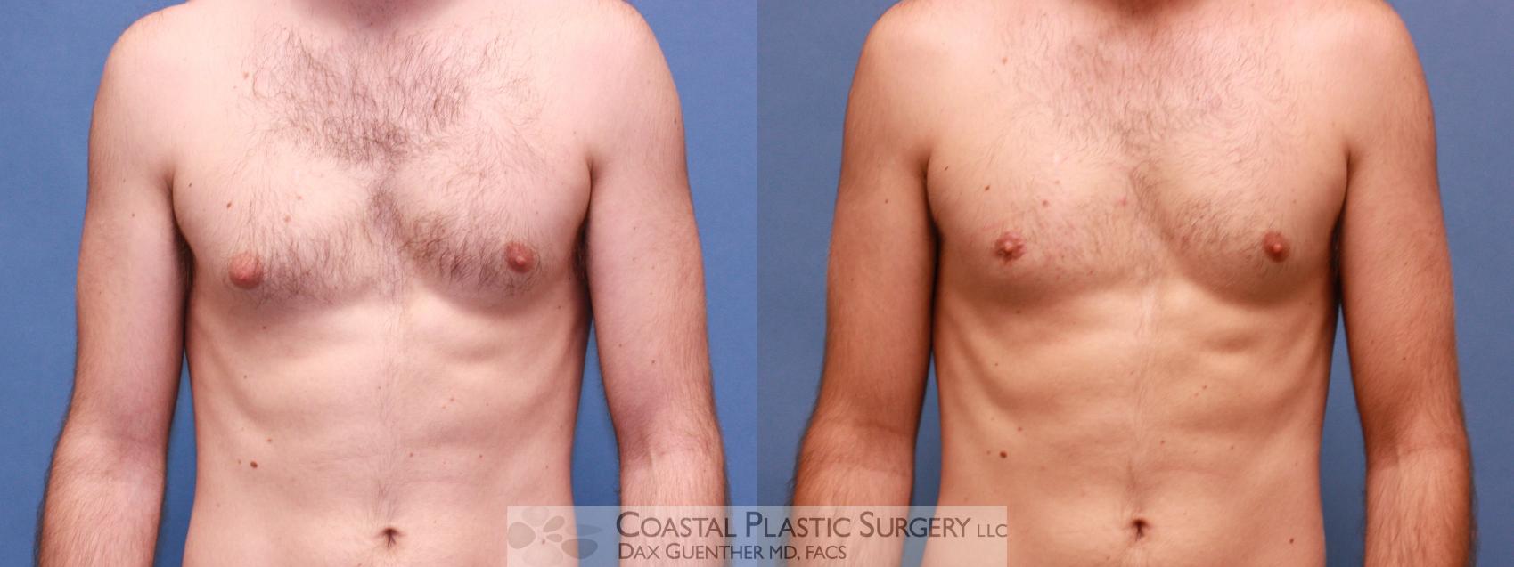 Before & After Male Breast Reduction (Gynecomastia) Case 28 View #1 View in Boston, MA