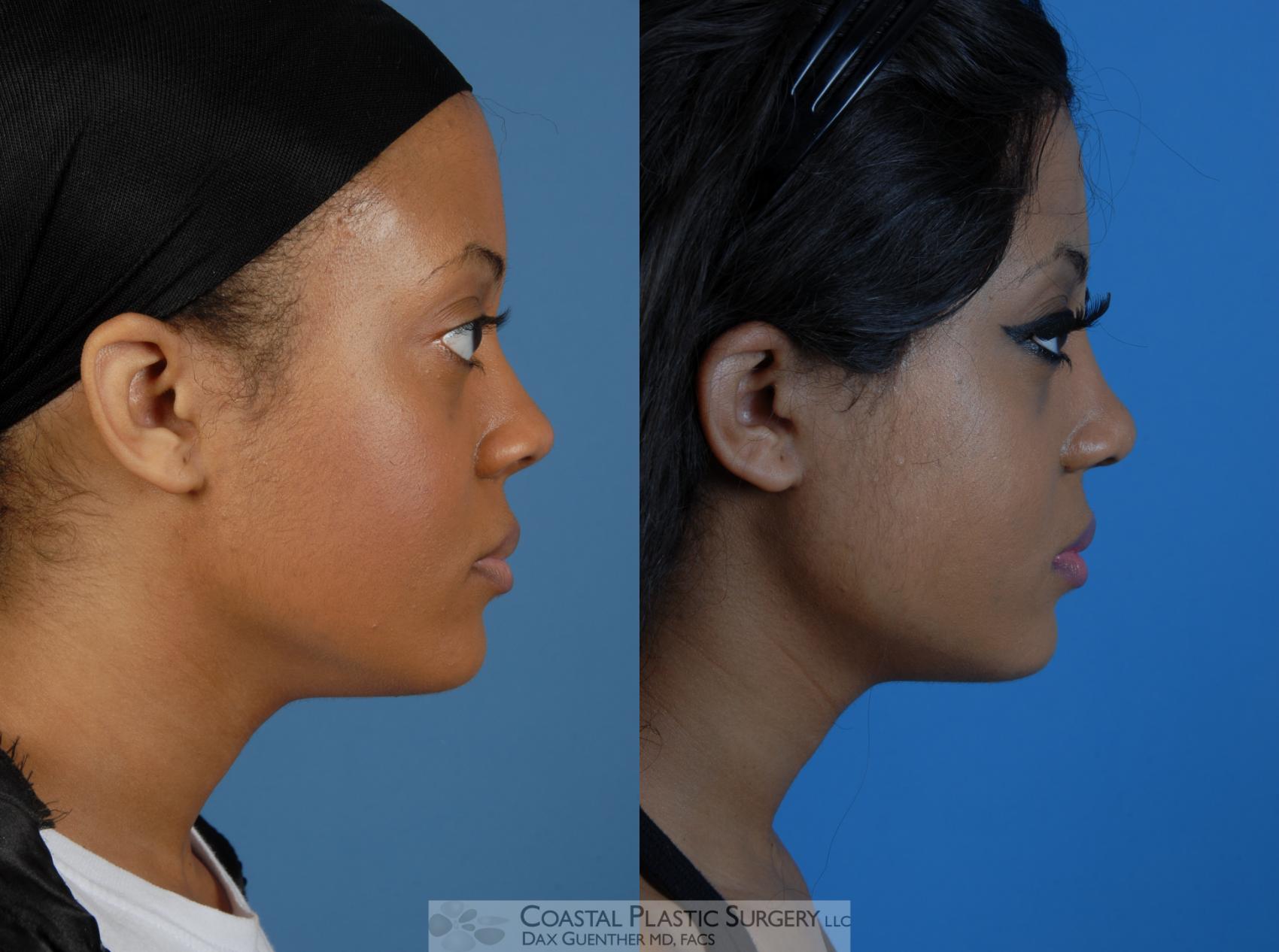 Before & After Rhinoplasty Case 3 View #1 View in Boston, MA