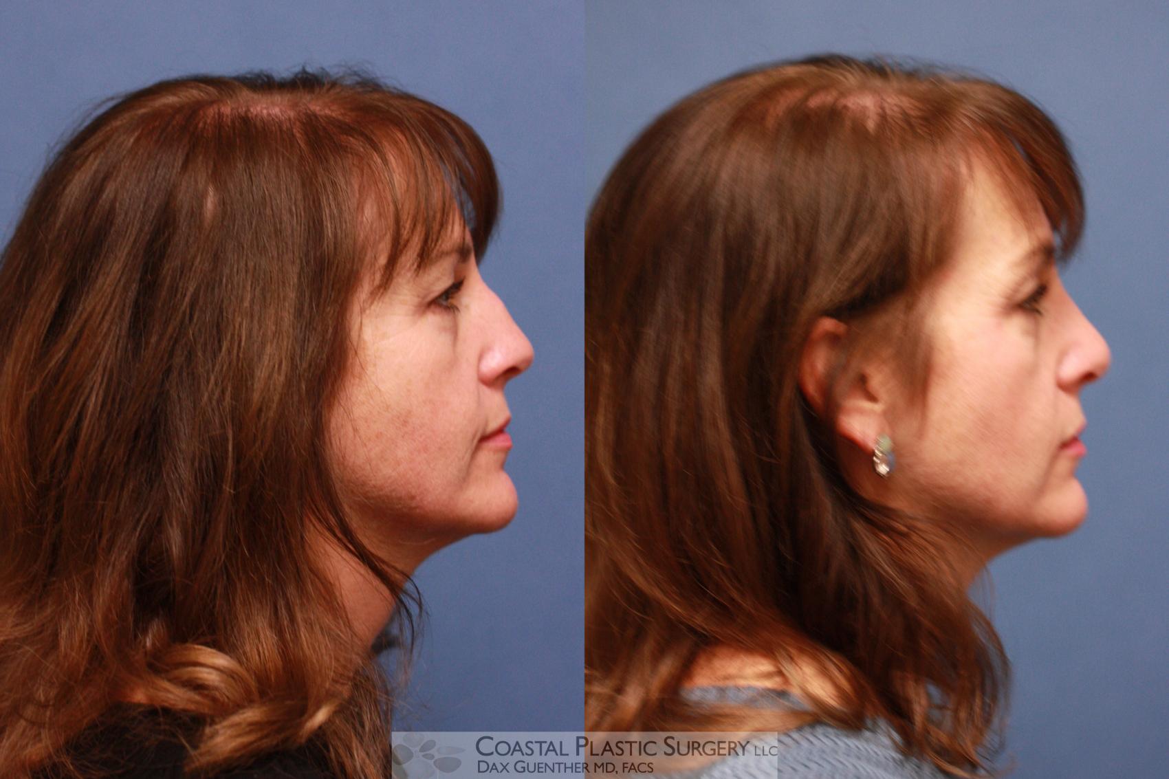 Before & After Rhinoplasty Case 71 View #3 View in Boston, MA