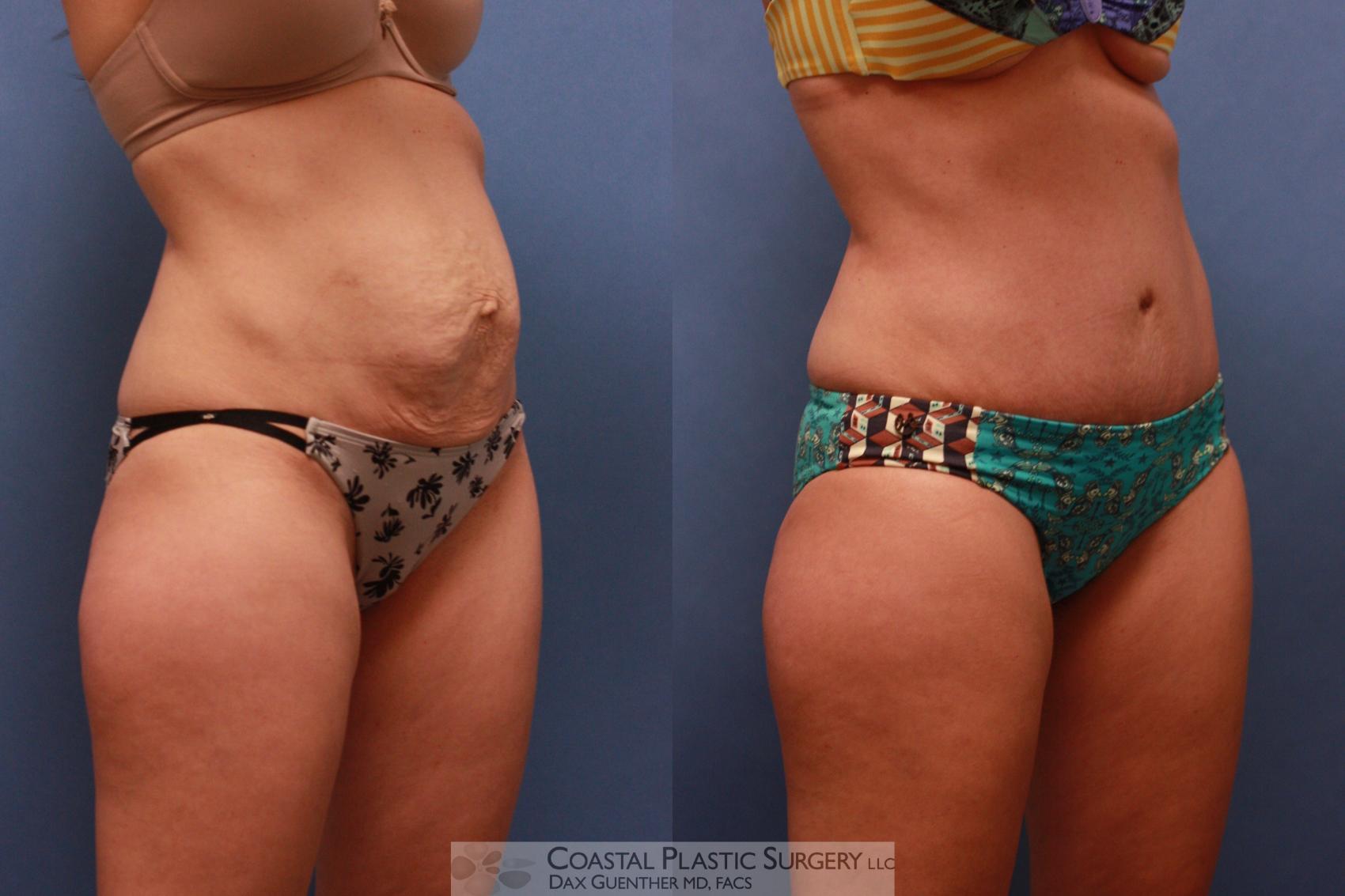 Before & After Tummy Tuck (Abdominoplasty) Case 88 View #1 View in Boston, MA