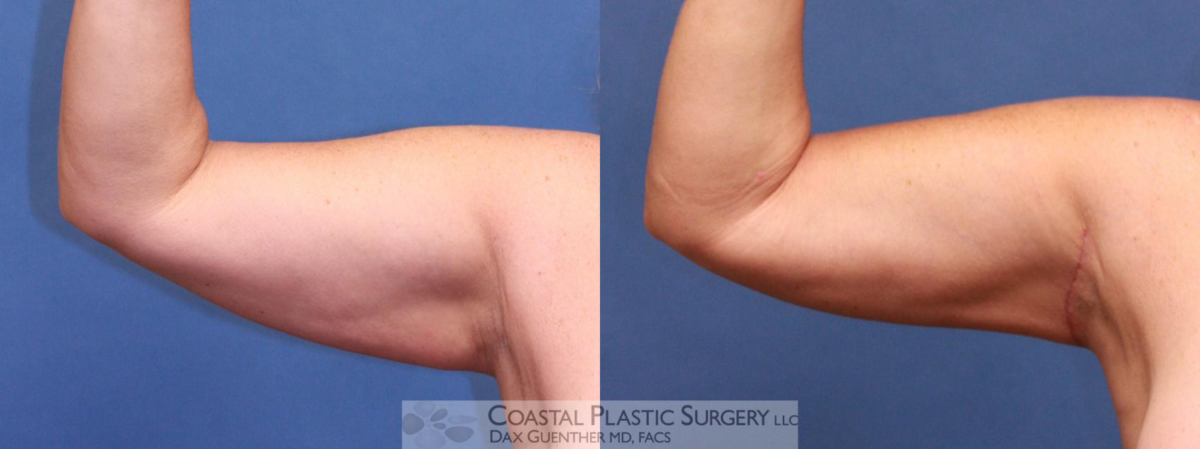 Before & After Arm Lift (Brachioplasty) Case 21 View #1 View in Hingham, MA