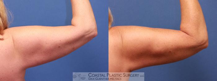 Before & After Arm Lift (Brachioplasty) Case 21 View #2 View in Boston, MA
