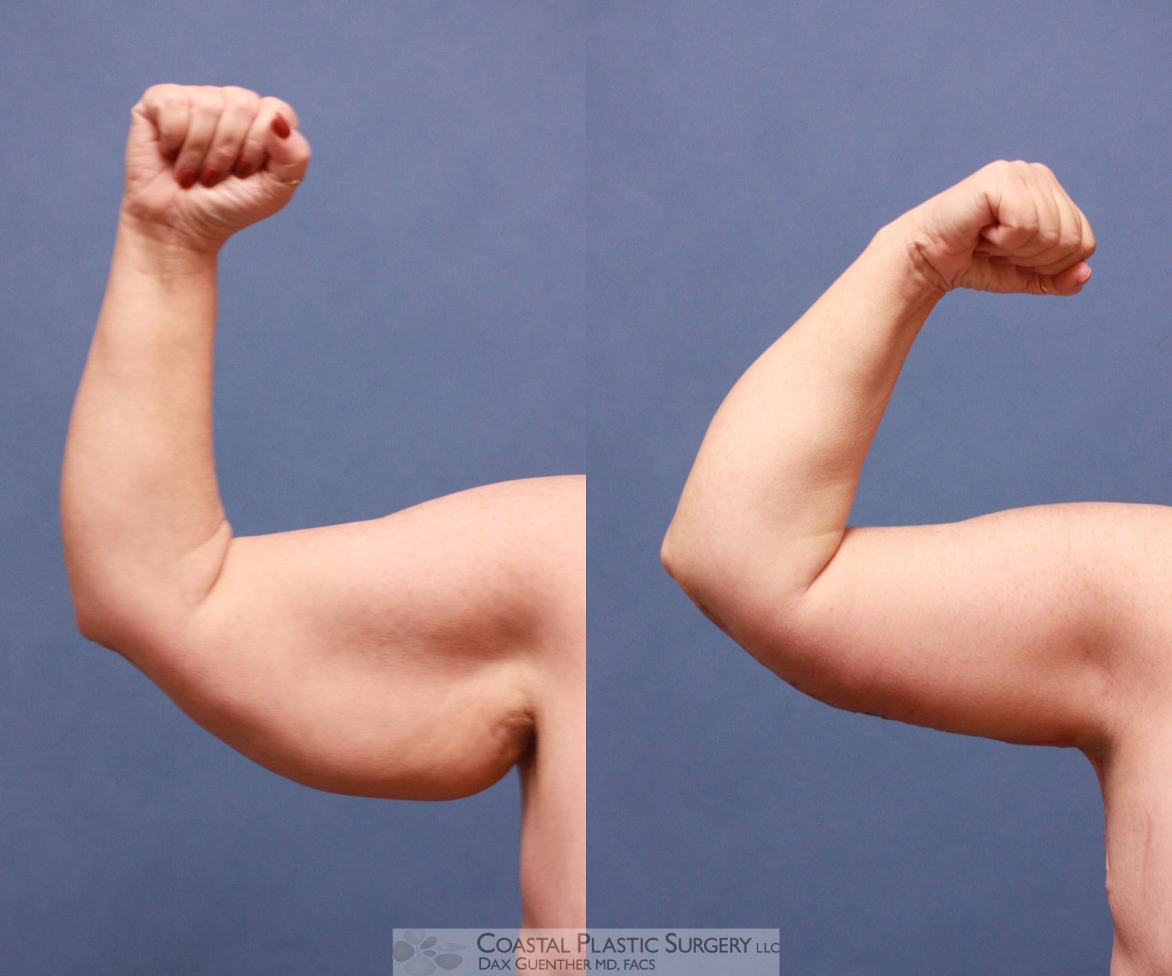 Before & After Arm Lift (Brachioplasty) Case 54 View #1 View in Hingham, MA