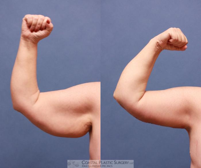 Before & After Arm Lift (Brachioplasty) Case 54 View #1 View in Boston, MA