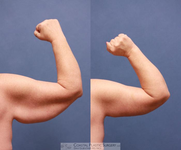 Before & After Arm Lift (Brachioplasty) Case 54 View #2 View in Boston, MA