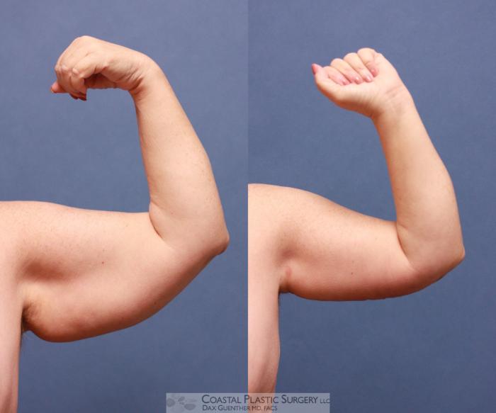 Before & After Arm Lift (Brachioplasty) Case 54 View #4 View in Boston, MA