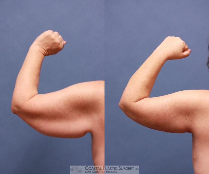 Before & After Arm Lift (Brachioplasty) Case 54 View #5 View in Boston, MA