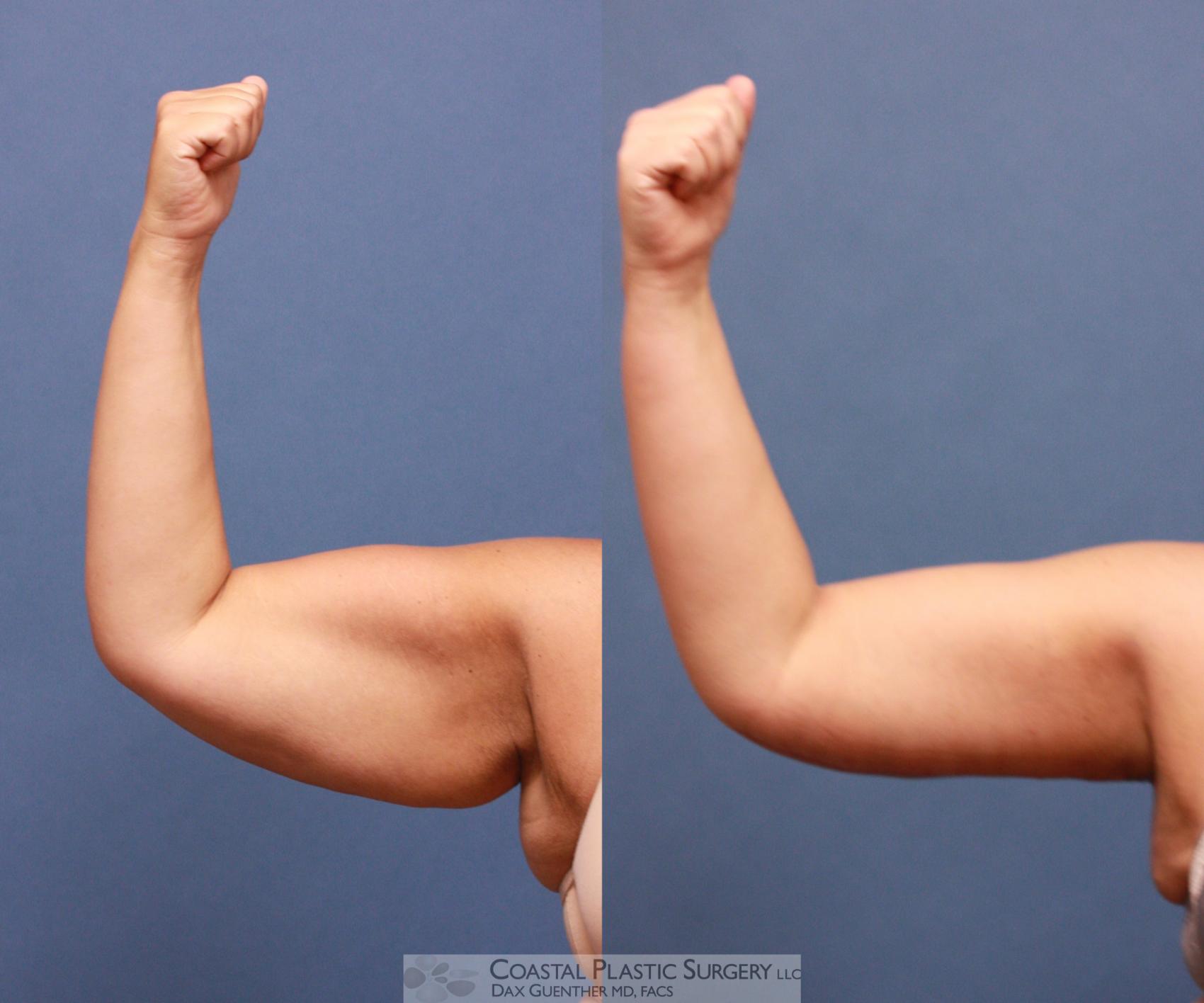 Before & After Arm Lift (Brachioplasty) Case 58 View #1 View in Hingham, MA