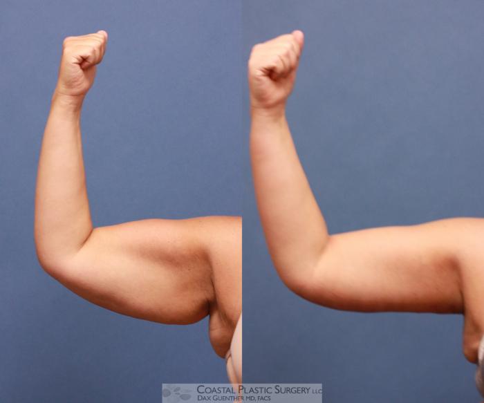 Before & After Arm Lift (Brachioplasty) Case 58 View #1 View in Boston, MA