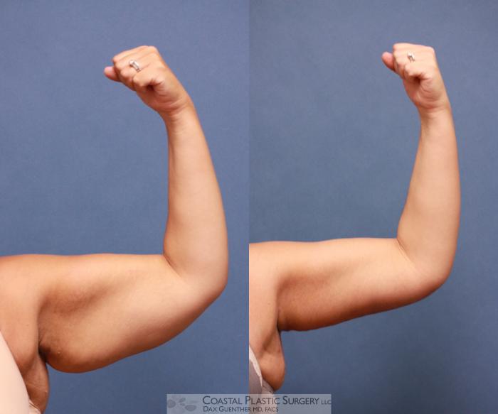 Before & After Arm Lift (Brachioplasty) Case 58 View #2 View in Boston, MA