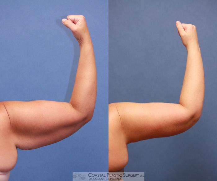 Before & After Arm Lift (Brachioplasty) Case 58 View #3 View in Boston, MA