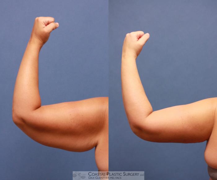 Before & After Arm Lift (Brachioplasty) Case 58 View #4 View in Boston, MA