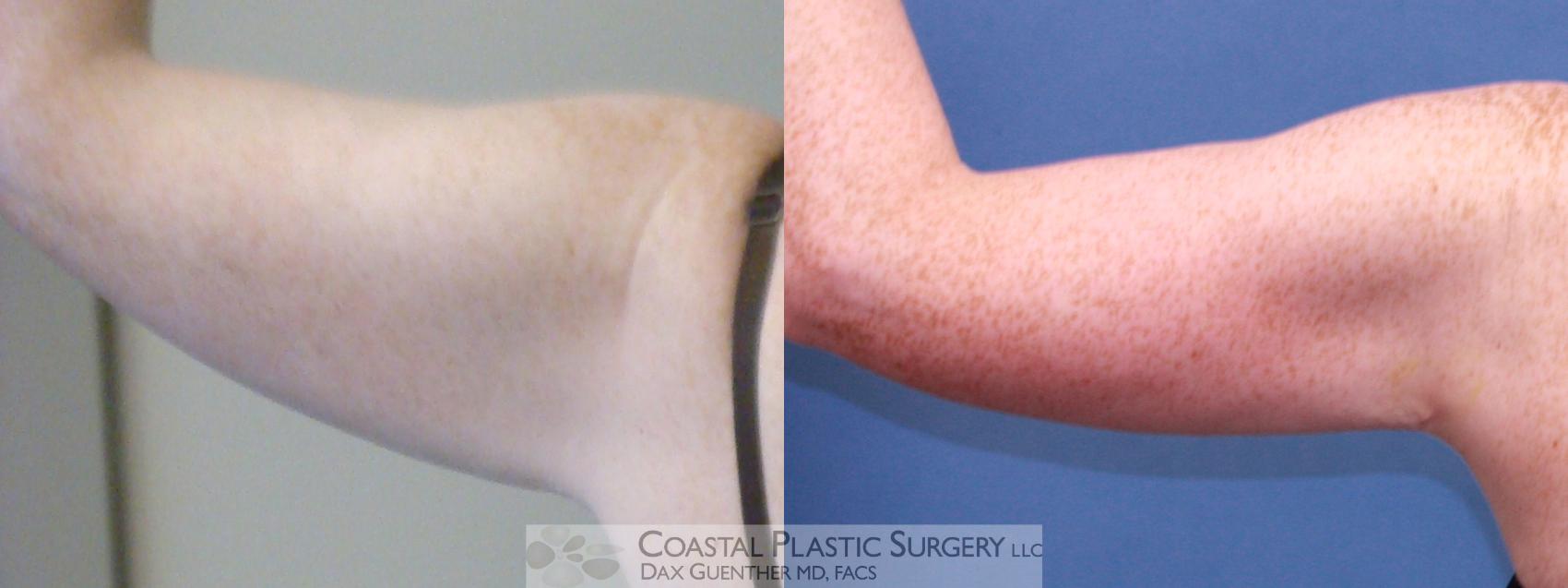 Before & After Arm Lift (Brachioplasty) Case 8 View #1 View in Hingham, MA
