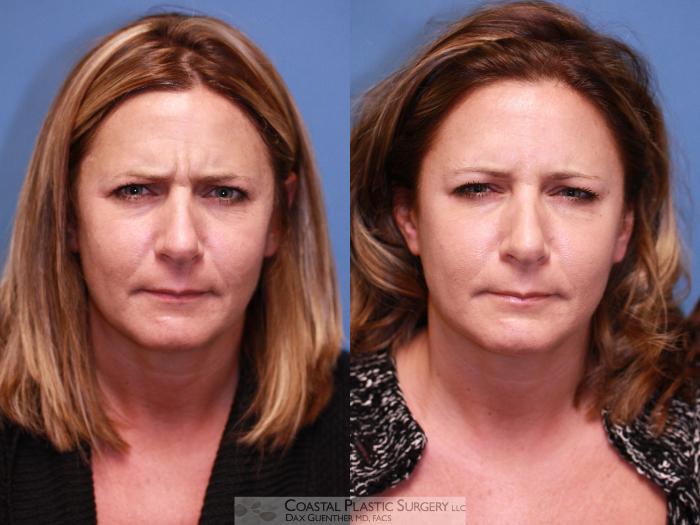 Before & After Botox & Dysport Case 12 Frowning View in Boston, MA