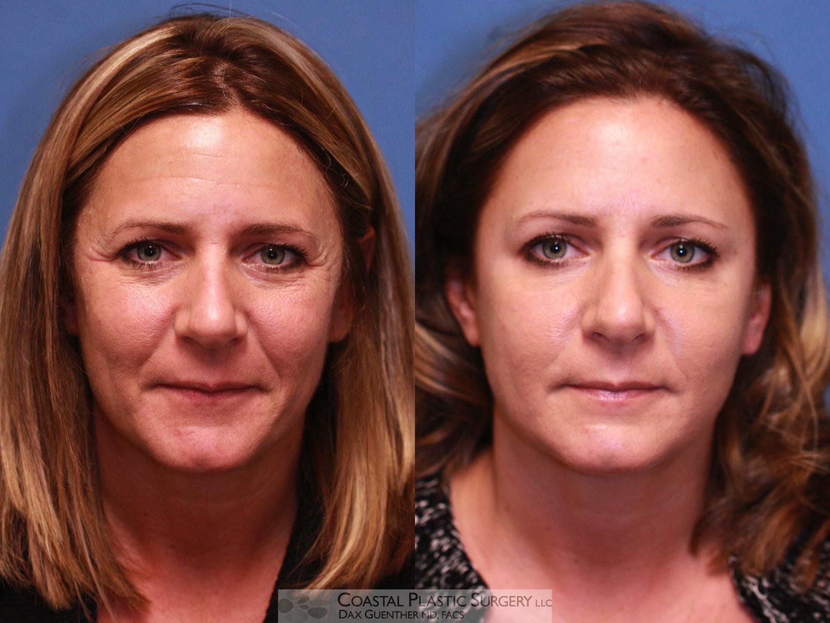 Before & After Botox & Dysport Case 12 In Repose View in Hingham, MA