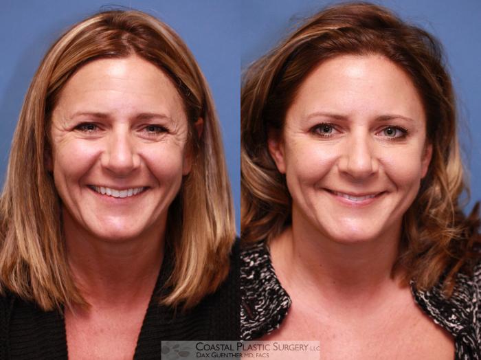 Before & After Botox & Dysport Case 12 Smiling View in Boston, MA