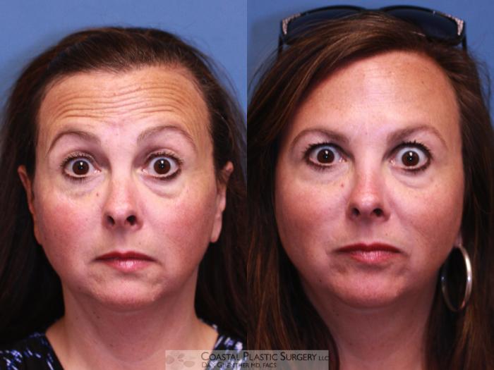 Before & After Botox & Dysport Case 31 Acting Surprised View in Hingham, MA