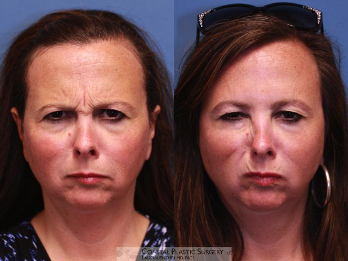Before & After Botox & Dysport Case 31 Frowning View in Hingham, MA