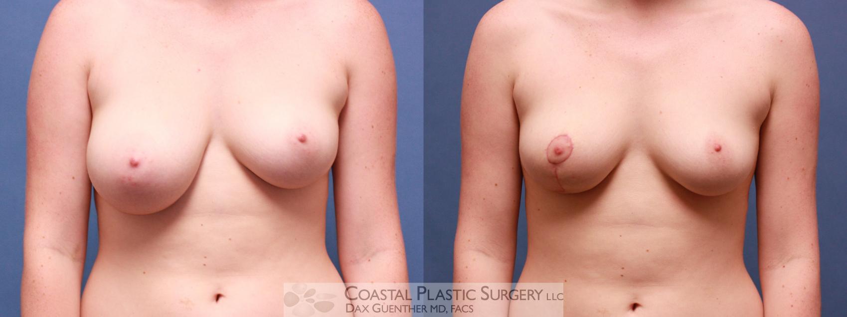 Before & After Breast Asymmetry Case 35 View #1 View in Hingham, Boston & Nantucket, MA