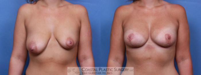 Before & After Breast Asymmetry Case 95 View #1 View in Boston, MA